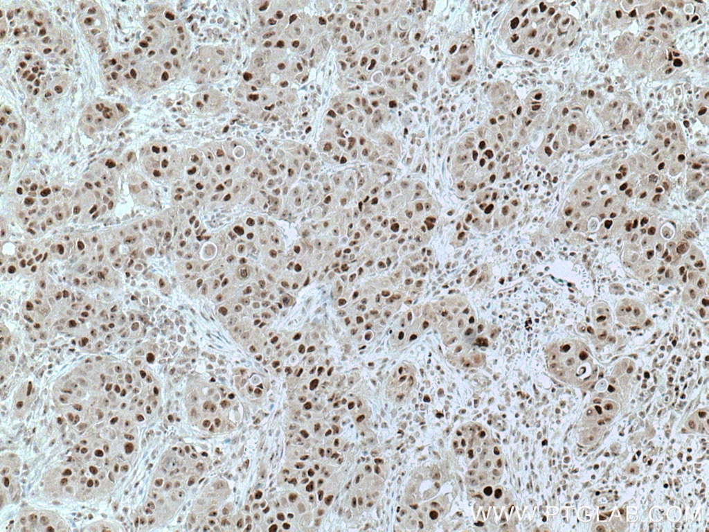 Immunohistochemistry (IHC) staining of human breast cancer tissue using UBE2E1 Polyclonal antibody (55457-1-AP)