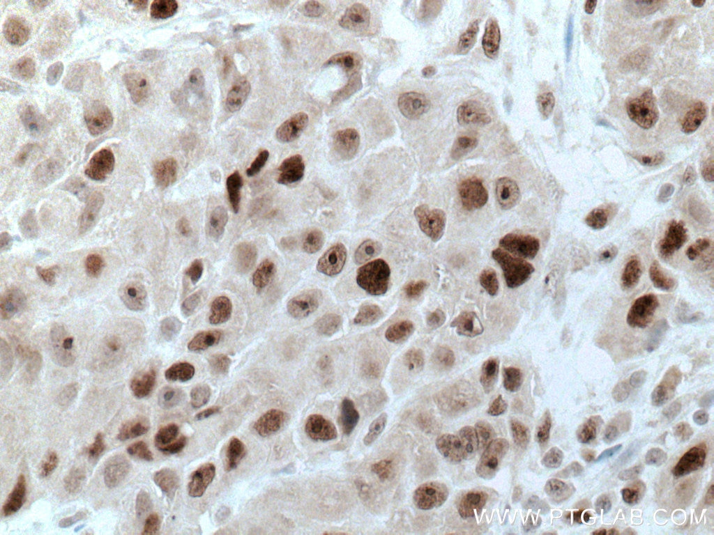 Immunohistochemistry (IHC) staining of human breast cancer tissue using UBE2E1 Polyclonal antibody (55457-1-AP)