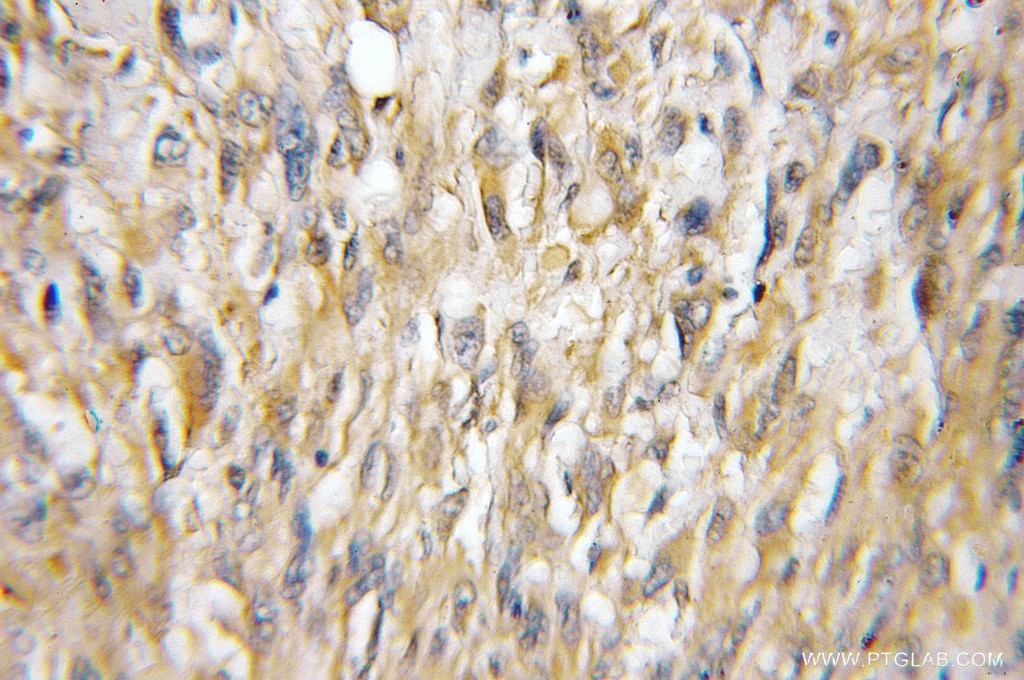 IHC staining of human gliomas using 11844-1-AP