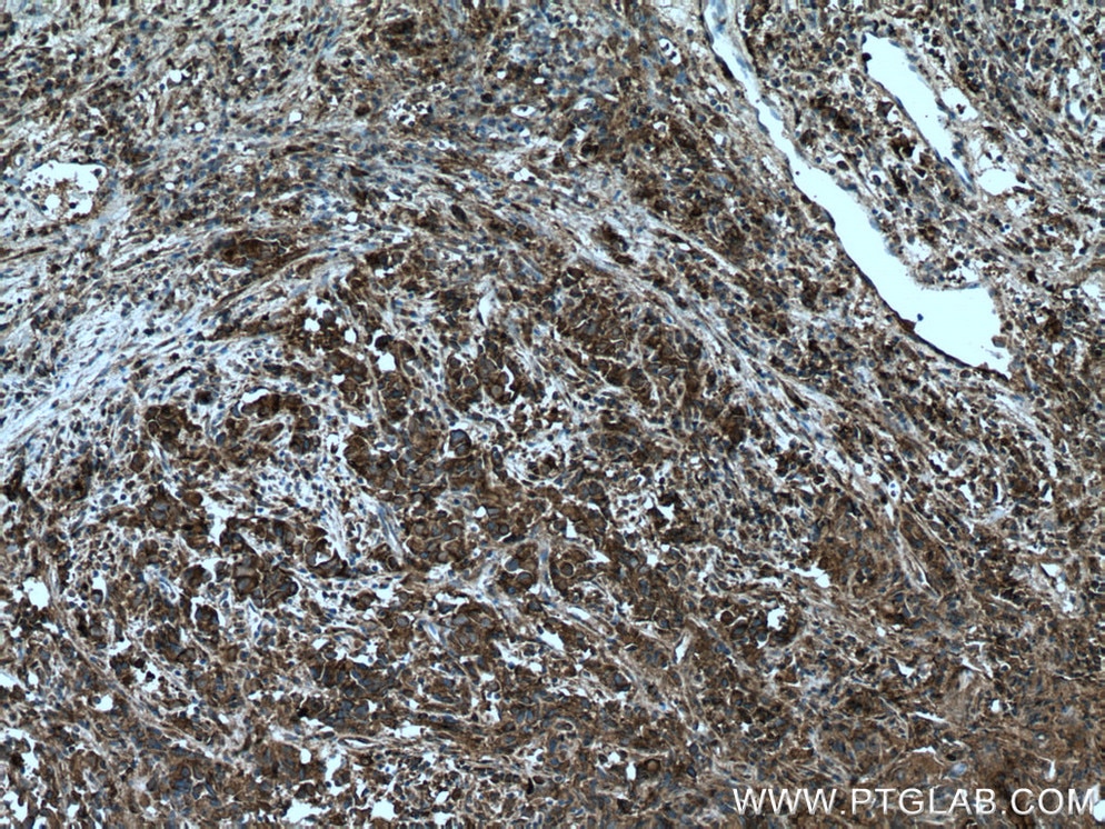 Immunohistochemistry (IHC) staining of human prostate cancer tissue using UBE2G2 Polyclonal antibody (10722-1-AP)