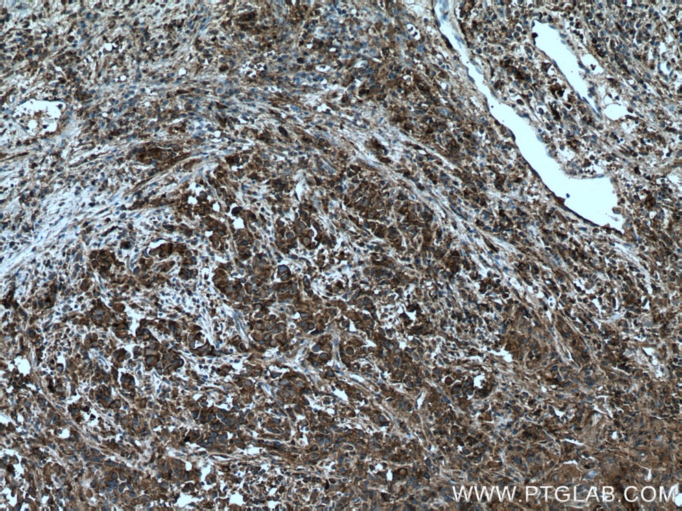 Immunohistochemistry (IHC) staining of human prostate cancer tissue using UBE2G2 Polyclonal antibody (10722-1-AP)