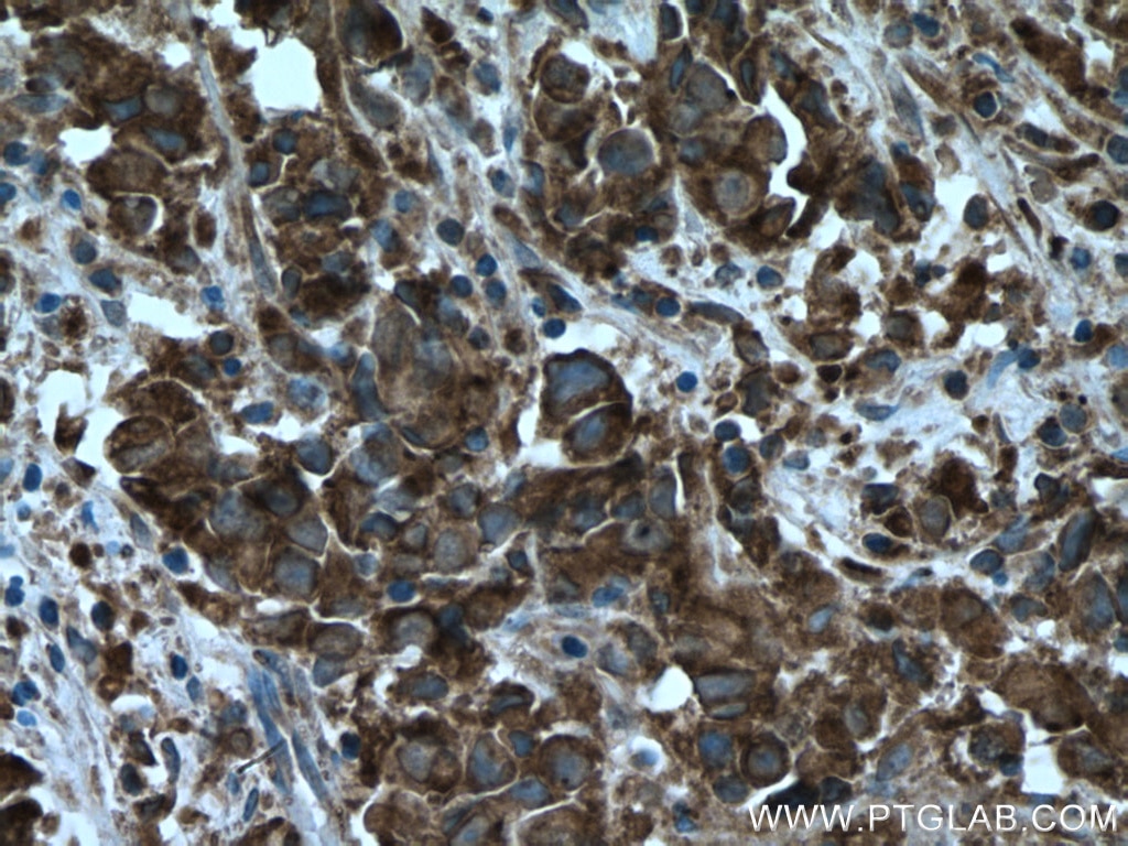 IHC staining of human prostate cancer using 10722-1-AP