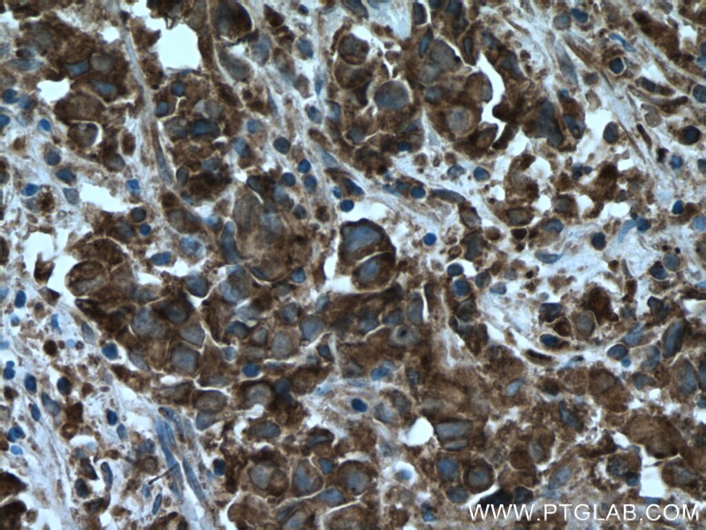 Immunohistochemistry (IHC) staining of human prostate cancer tissue using UBE2G2 Polyclonal antibody (10722-1-AP)