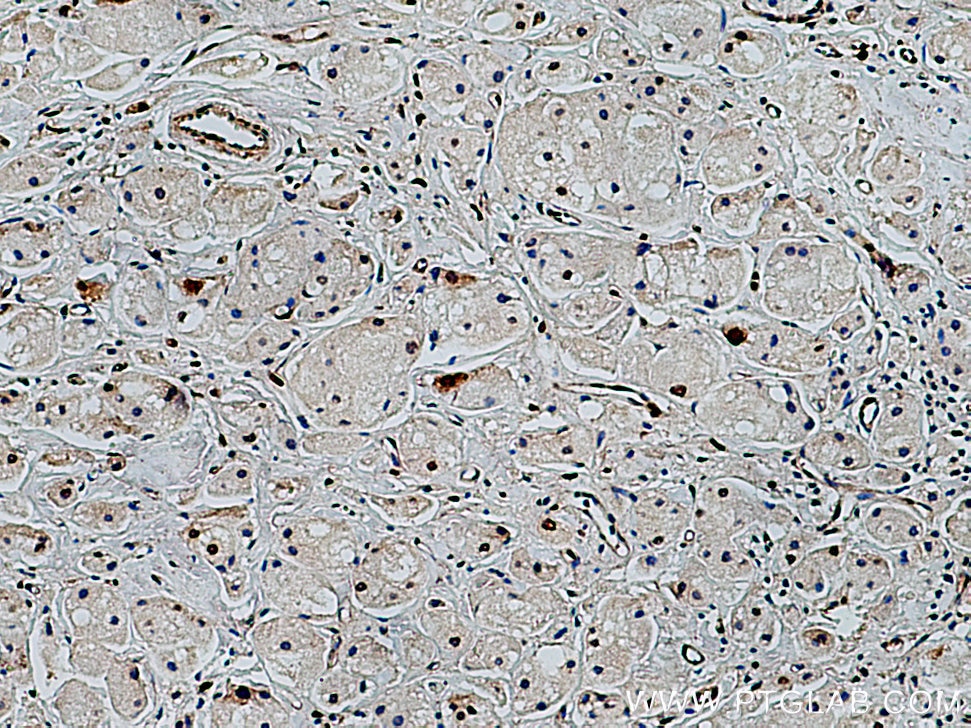 Immunohistochemistry (IHC) staining of human breast cancer tissue using UBC9-Specific Polyclonal antibody (14837-1-AP)