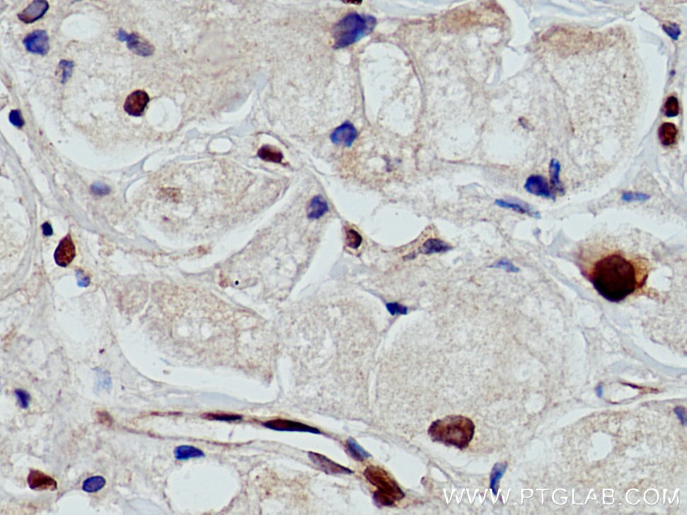 Immunohistochemistry (IHC) staining of human breast cancer tissue using UBC9-Specific Polyclonal antibody (14837-1-AP)