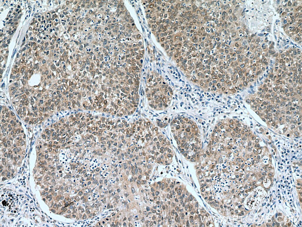 Immunohistochemistry (IHC) staining of human lung cancer tissue using UBC9-Specific Polyclonal antibody (14837-1-AP)