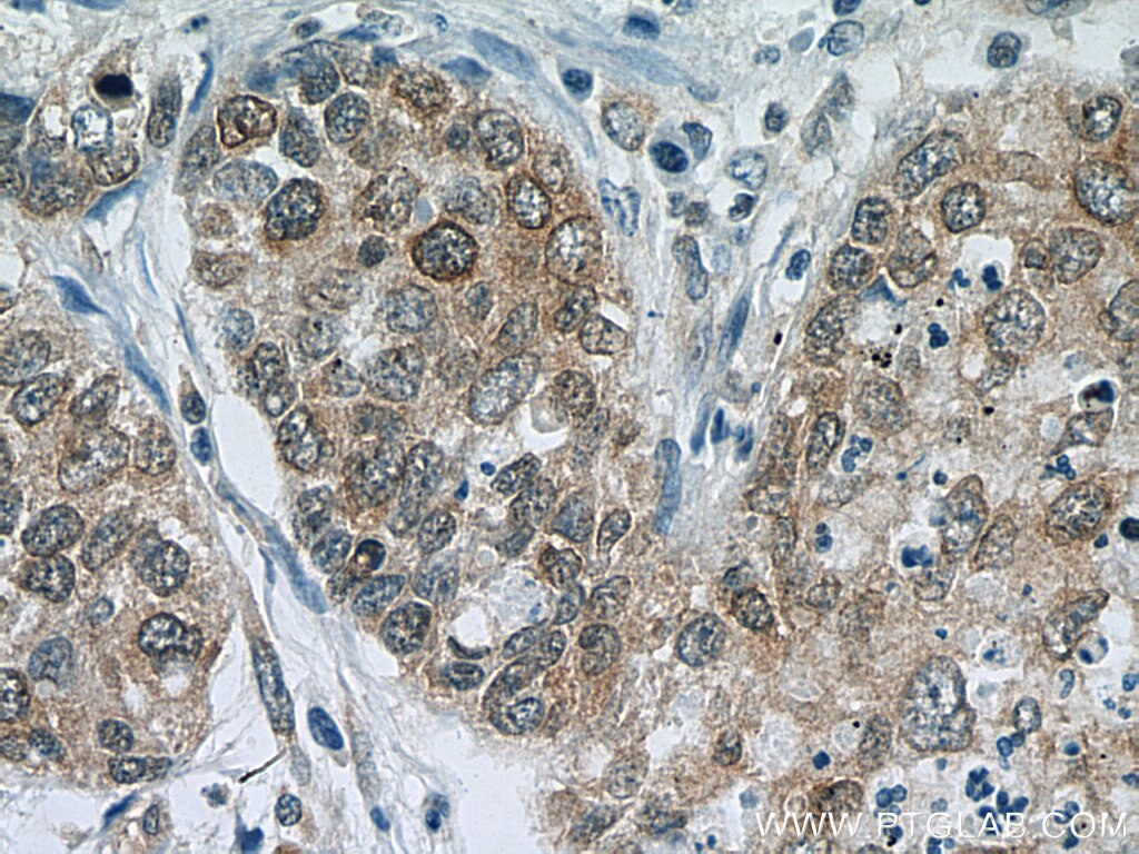 Immunohistochemistry (IHC) staining of human lung cancer tissue using UBC9-Specific Polyclonal antibody (14837-1-AP)