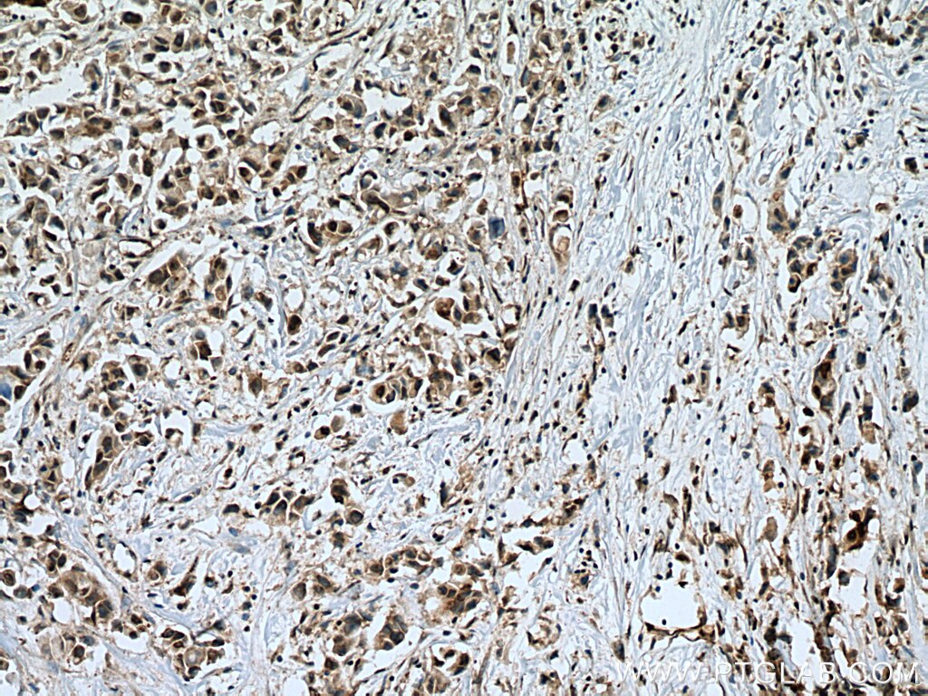 Immunohistochemistry (IHC) staining of human breast cancer tissue using UBC9-Specific Polyclonal antibody (14837-1-AP)