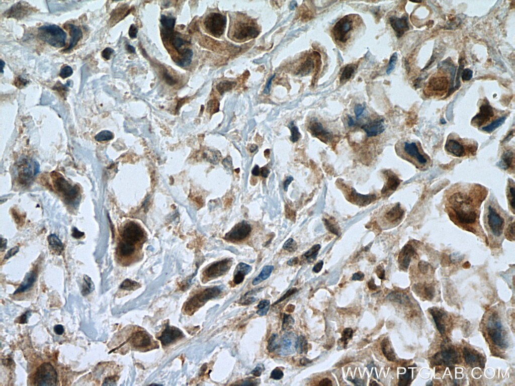 Immunohistochemistry (IHC) staining of human breast cancer tissue using UBC9-Specific Polyclonal antibody (14837-1-AP)