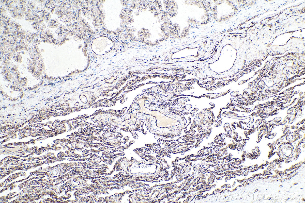 Immunohistochemistry (IHC) staining of human lung cancer tissue using UBC9-Specific Polyclonal antibody (14837-1-AP)