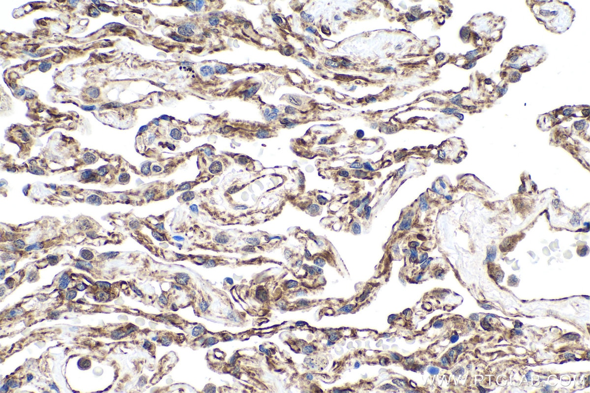 Immunohistochemistry (IHC) staining of human lung cancer tissue using UBC9-Specific Polyclonal antibody (14837-1-AP)