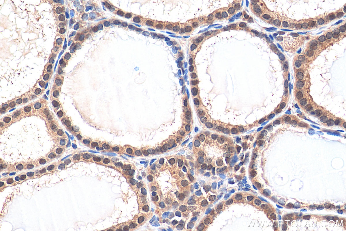 Immunohistochemistry (IHC) staining of human thyroid cancer tissue using UBE2K Polyclonal antibody (11834-3-AP)