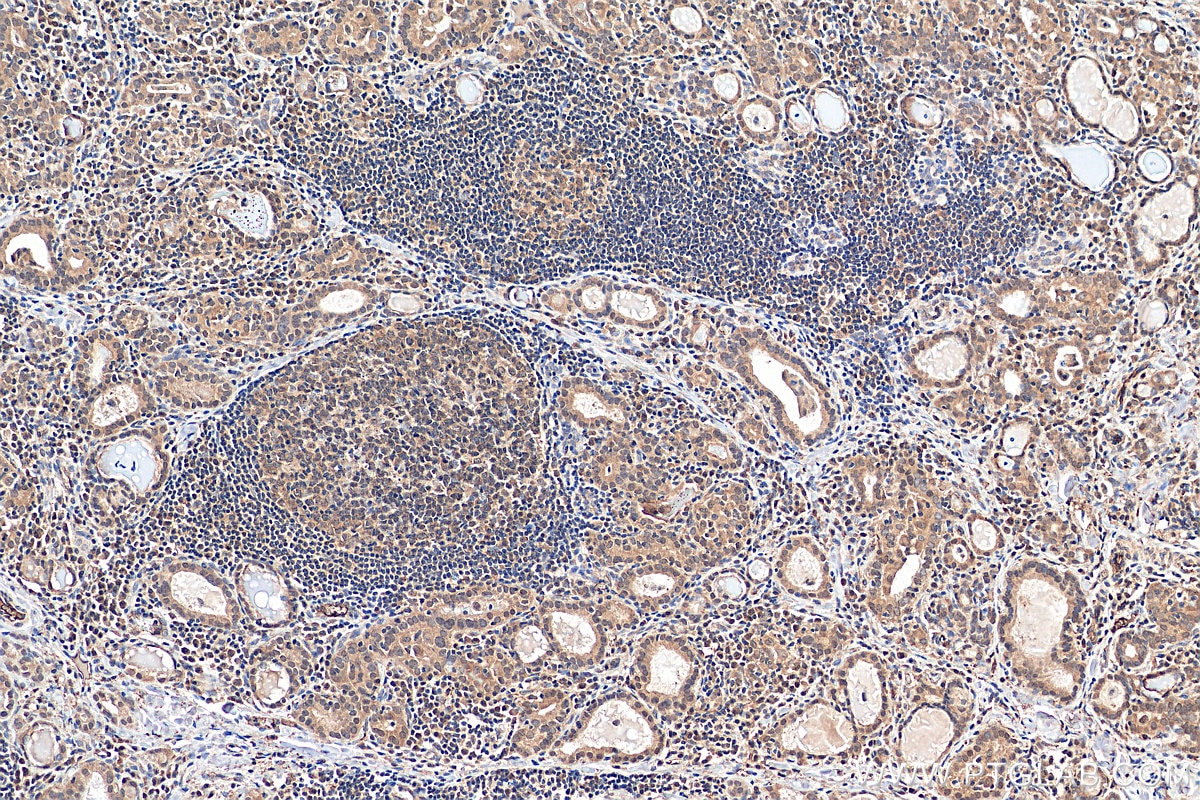 Immunohistochemistry (IHC) staining of human thyroid cancer tissue using UBE2K Polyclonal antibody (11834-3-AP)