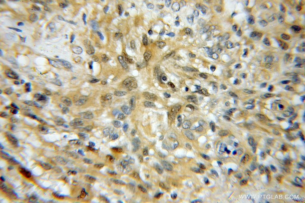IHC staining of human gliomas using 11834-3-AP