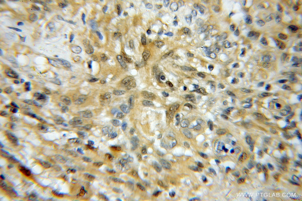 Immunohistochemistry (IHC) staining of human gliomas tissue using UBE2K Polyclonal antibody (11834-3-AP)