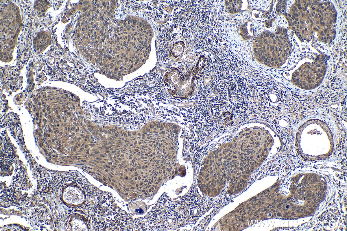 Immunohistochemistry (IHC) staining of human lung cancer tissue using UBE2L3 Polyclonal antibody (14415-1-AP)