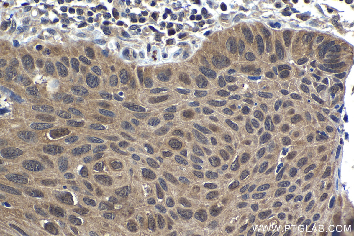 Immunohistochemistry (IHC) staining of human lung cancer tissue using UBE2L3 Polyclonal antibody (14415-1-AP)