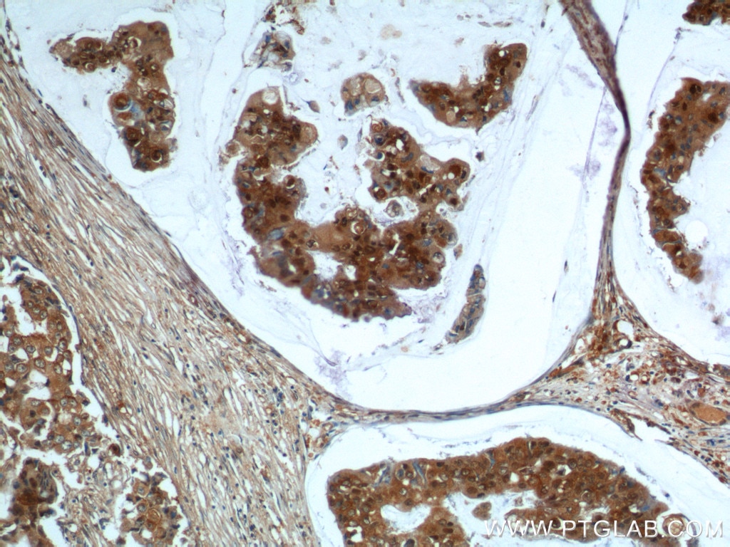 Immunohistochemistry (IHC) staining of human breast cancer tissue using UBC13 Polyclonal antibody (10243-1-AP)