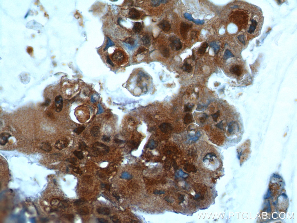 Immunohistochemistry (IHC) staining of human breast cancer tissue using UBC13 Polyclonal antibody (10243-1-AP)