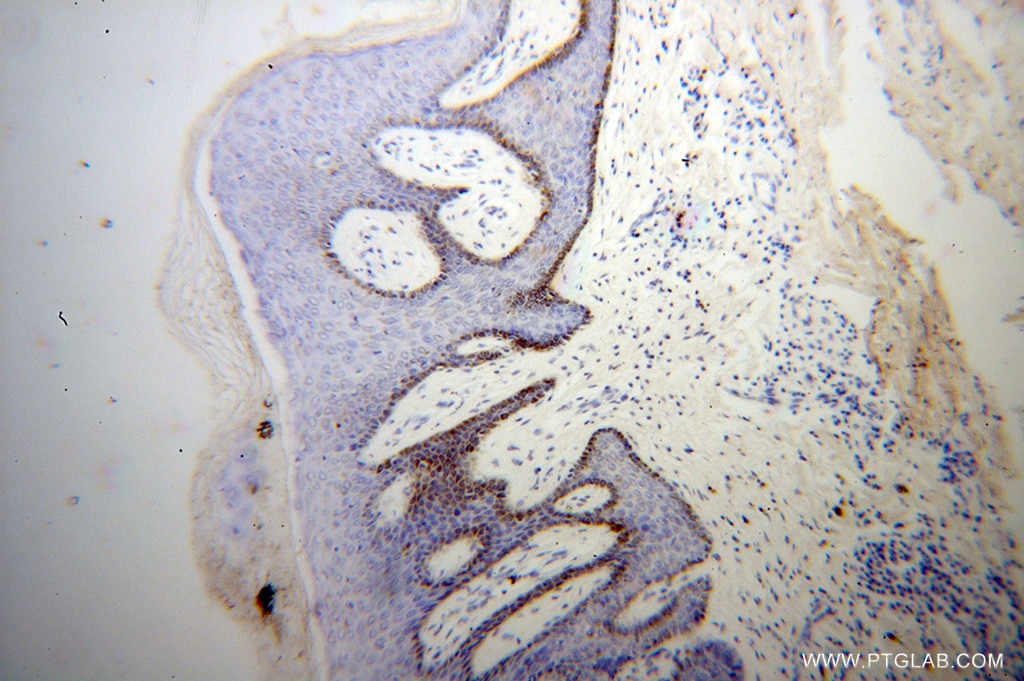 Immunohistochemistry (IHC) staining of human skin cancer tissue using UBE2Q2 Polyclonal antibody (12581-1-AP)