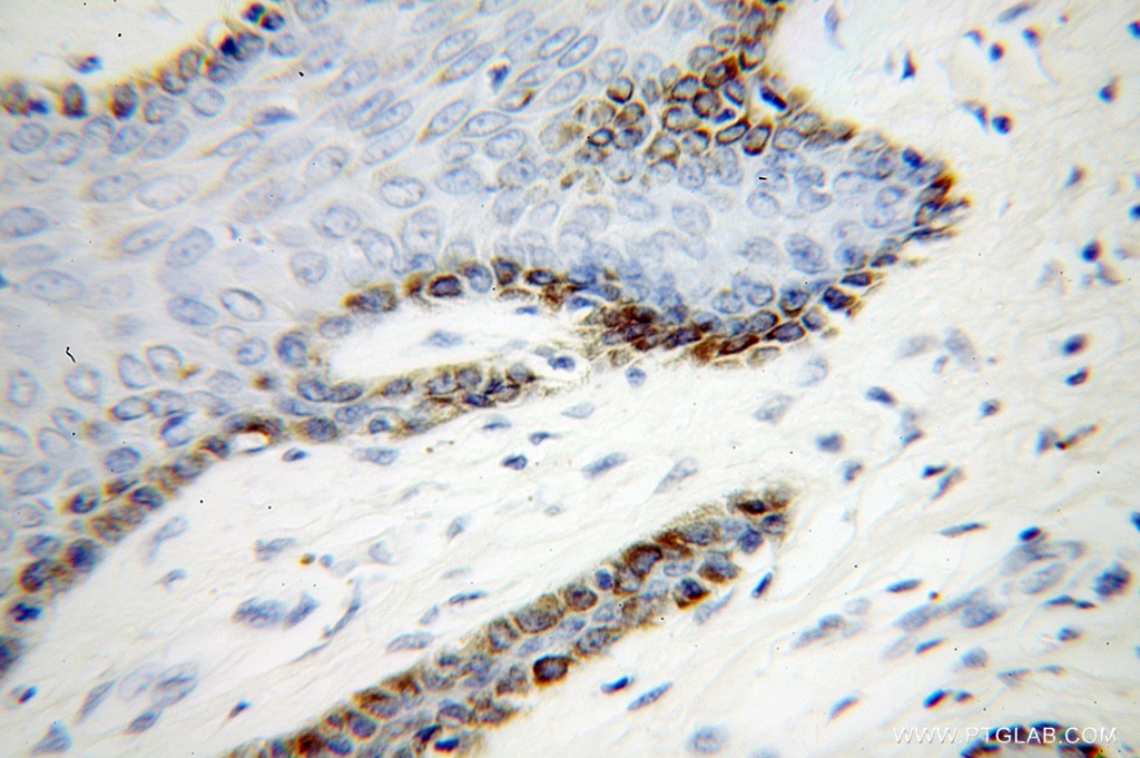 Immunohistochemistry (IHC) staining of human skin cancer tissue using UBE2Q2 Polyclonal antibody (12581-1-AP)