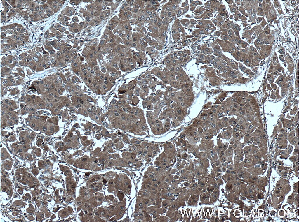 Immunohistochemistry (IHC) staining of human liver cancer tissue using UBE2S Polyclonal antibody (14115-1-AP)