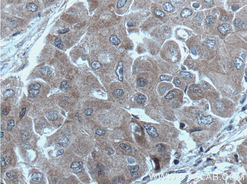 Immunohistochemistry (IHC) staining of human liver cancer tissue using UBE2S Polyclonal antibody (14115-1-AP)