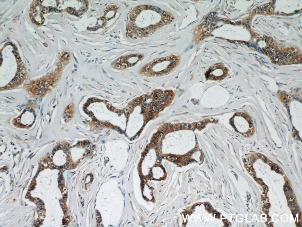 Immunohistochemistry (IHC) staining of human breast cancer tissue using UBE2S Polyclonal antibody (14115-1-AP)