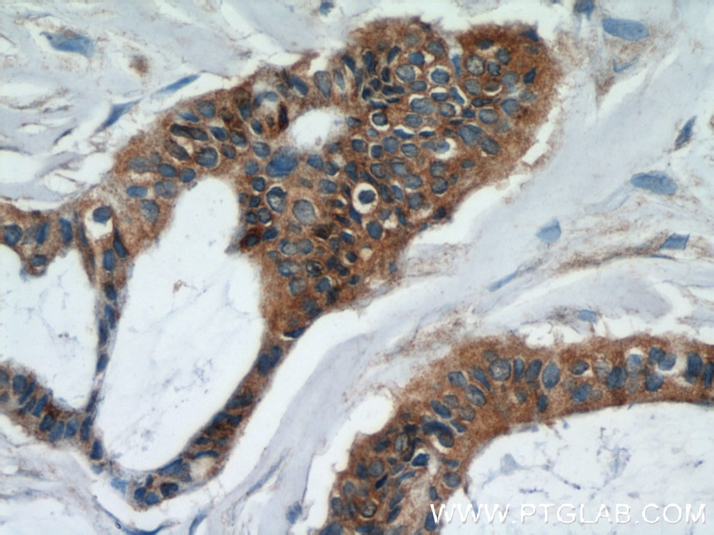 Immunohistochemistry (IHC) staining of human breast cancer tissue using UBE2S Polyclonal antibody (14115-1-AP)