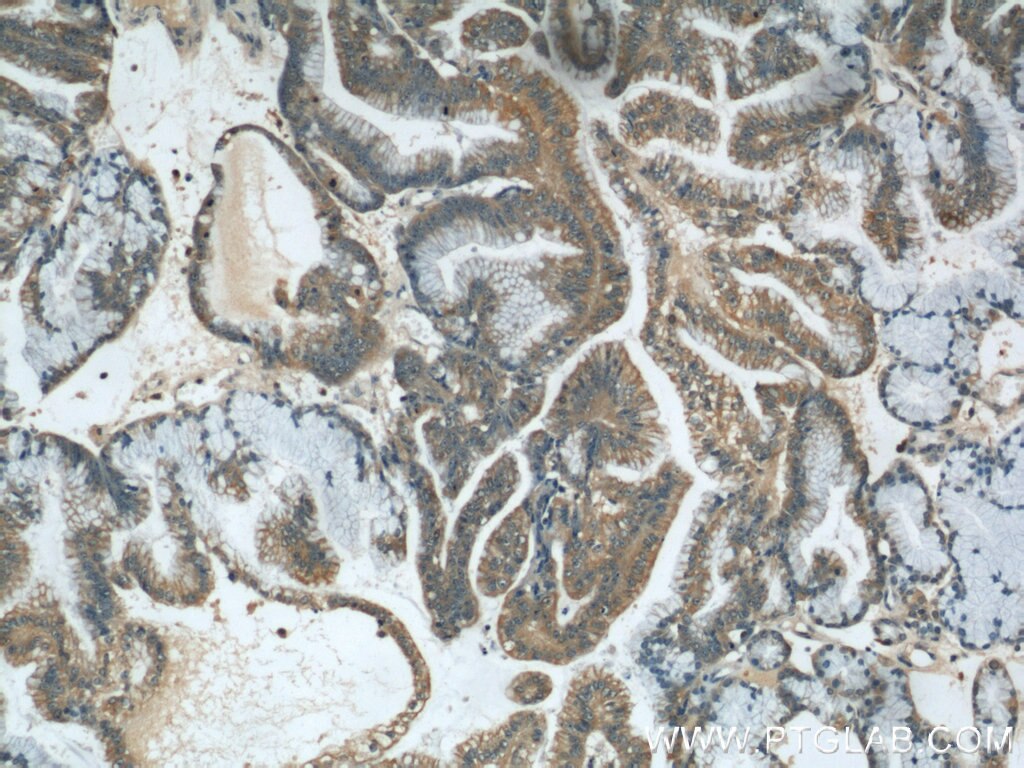 Immunohistochemistry (IHC) staining of human ovary tumor tissue using UBE2S Polyclonal antibody (14115-1-AP)