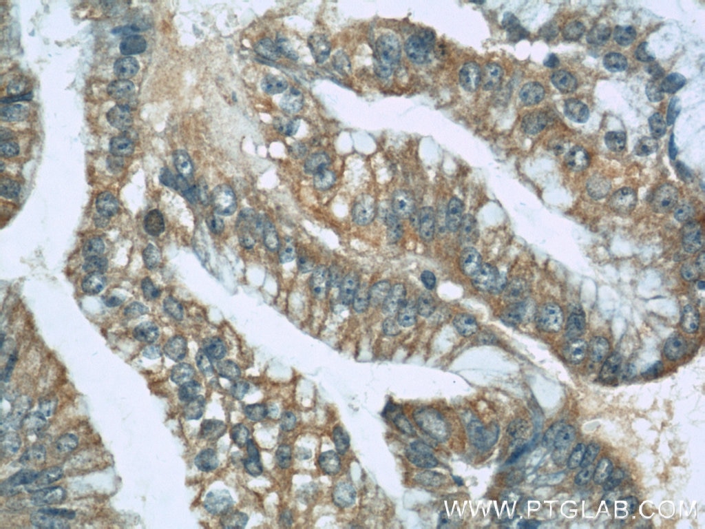 Immunohistochemistry (IHC) staining of human ovary tumor tissue using UBE2S Polyclonal antibody (14115-1-AP)
