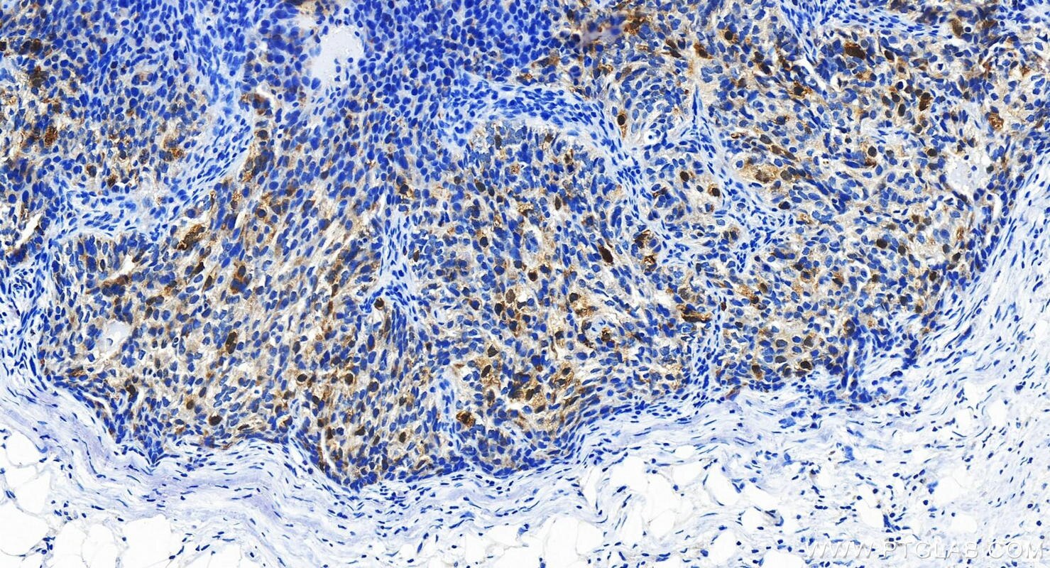 Immunohistochemistry (IHC) staining of human ovary cancer tissue using UBE2S Polyclonal antibody (18219-1-AP)