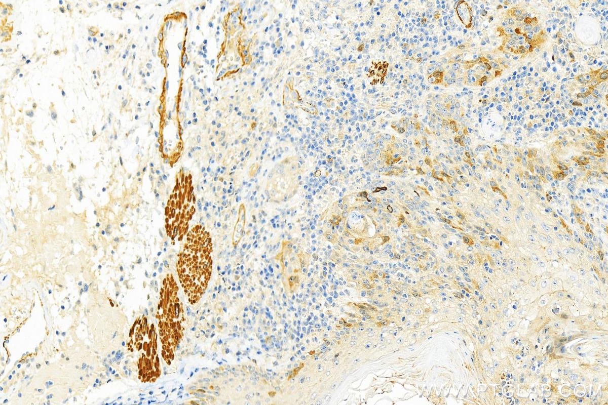 Immunohistochemistry (IHC) staining of human skin cancer tissue using UBE2S Polyclonal antibody (18219-1-AP)
