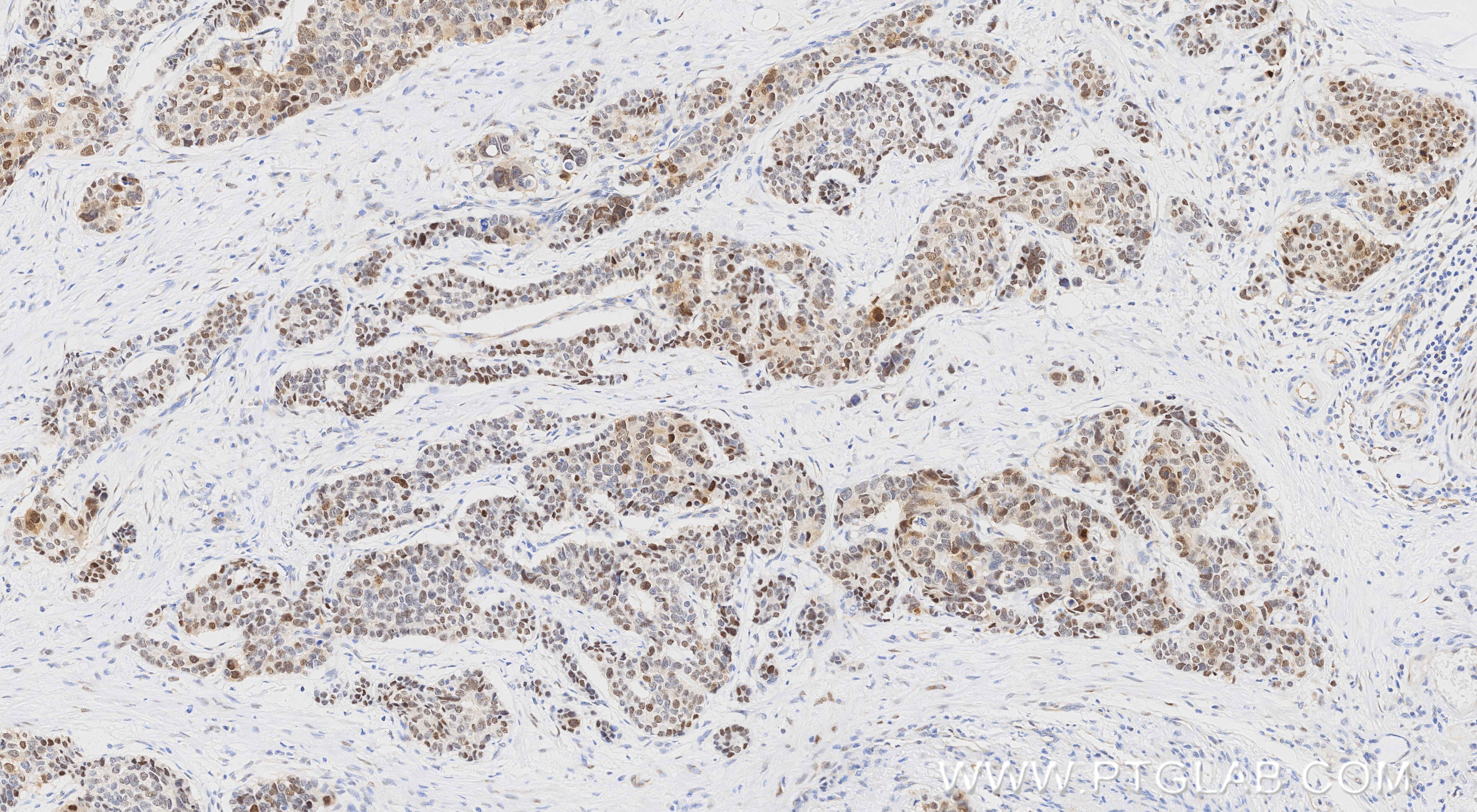 Immunohistochemistry (IHC) staining of human stomach cancer tissue using UBE2T/HSPC150 Recombinant monoclonal antibody (86278-1-RR)