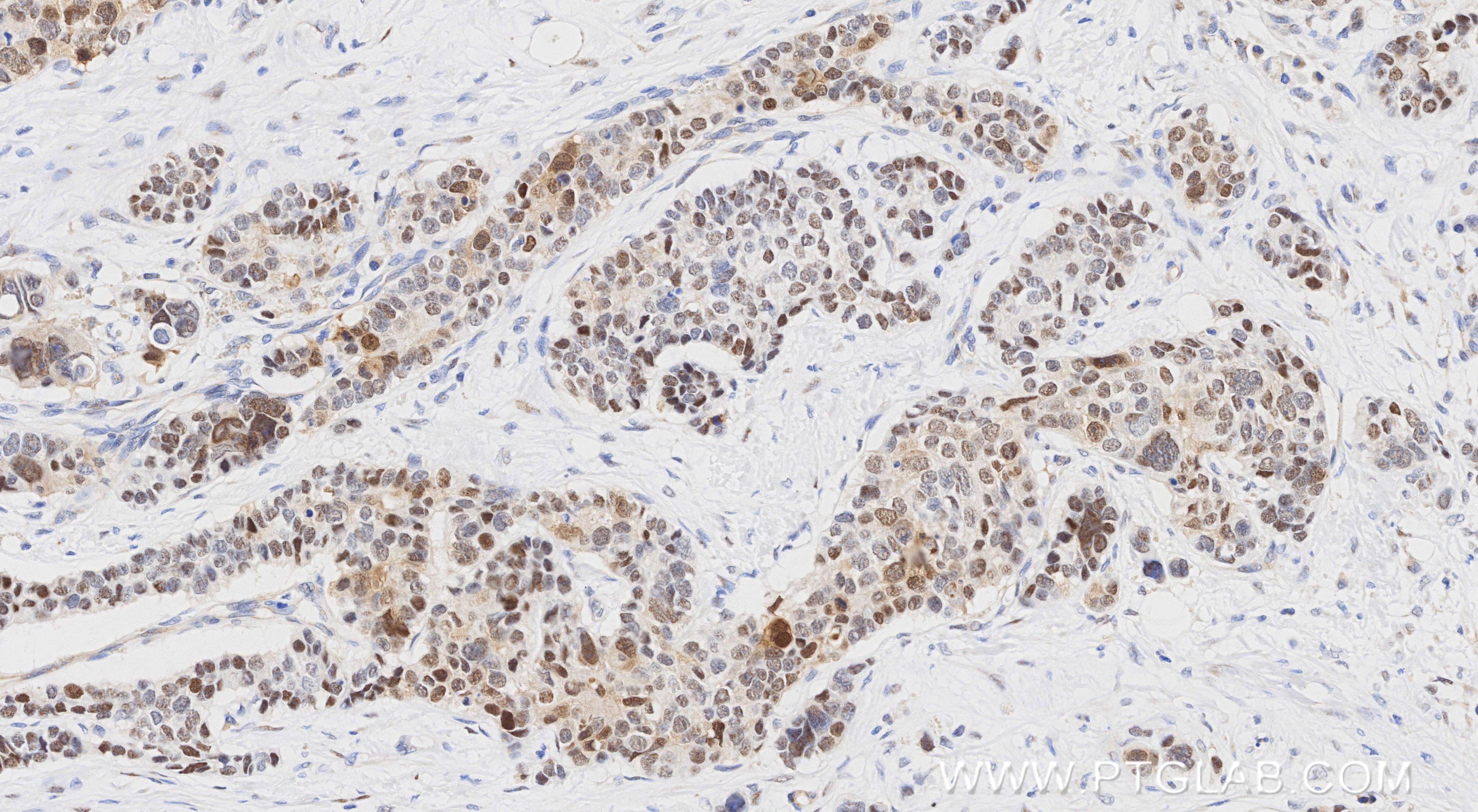 Immunohistochemistry (IHC) staining of human stomach cancer tissue using UBE2T/HSPC150 Recombinant monoclonal antibody (86278-1-RR)