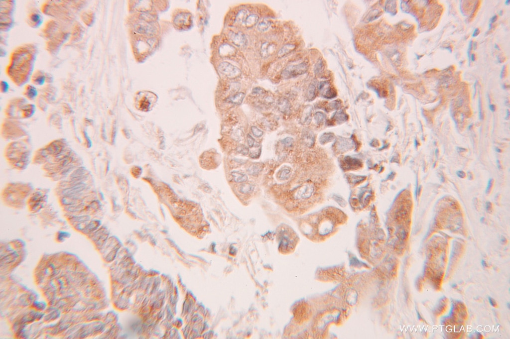 Immunohistochemistry (IHC) staining of human colon cancer tissue using MMS2 Polyclonal antibody (10689-1-AP)