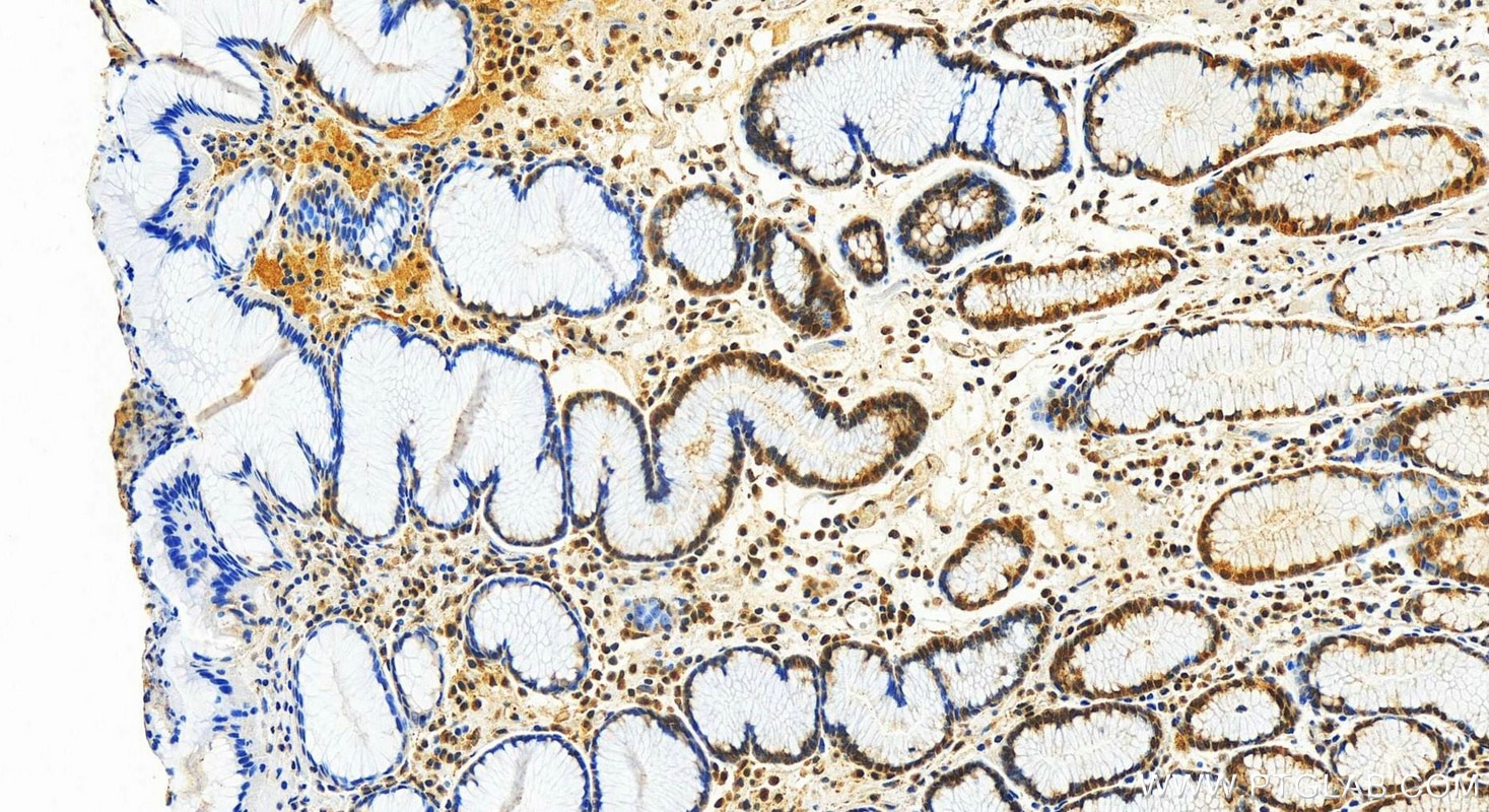 Immunohistochemistry (IHC) staining of human stomach cancer tissue using UBE4B Polyclonal antibody (18148-1-AP)