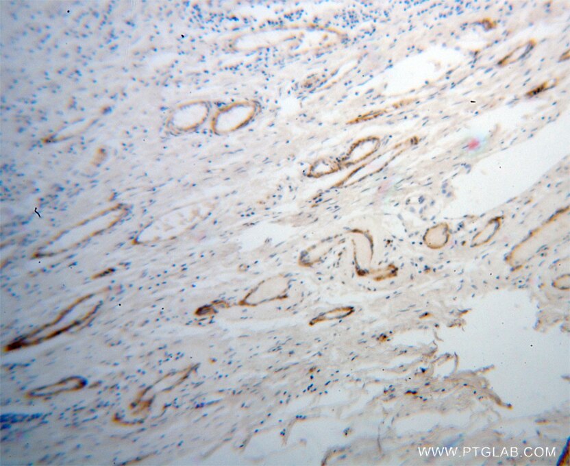 IHC staining of human ovary tumor using 14253-1-AP