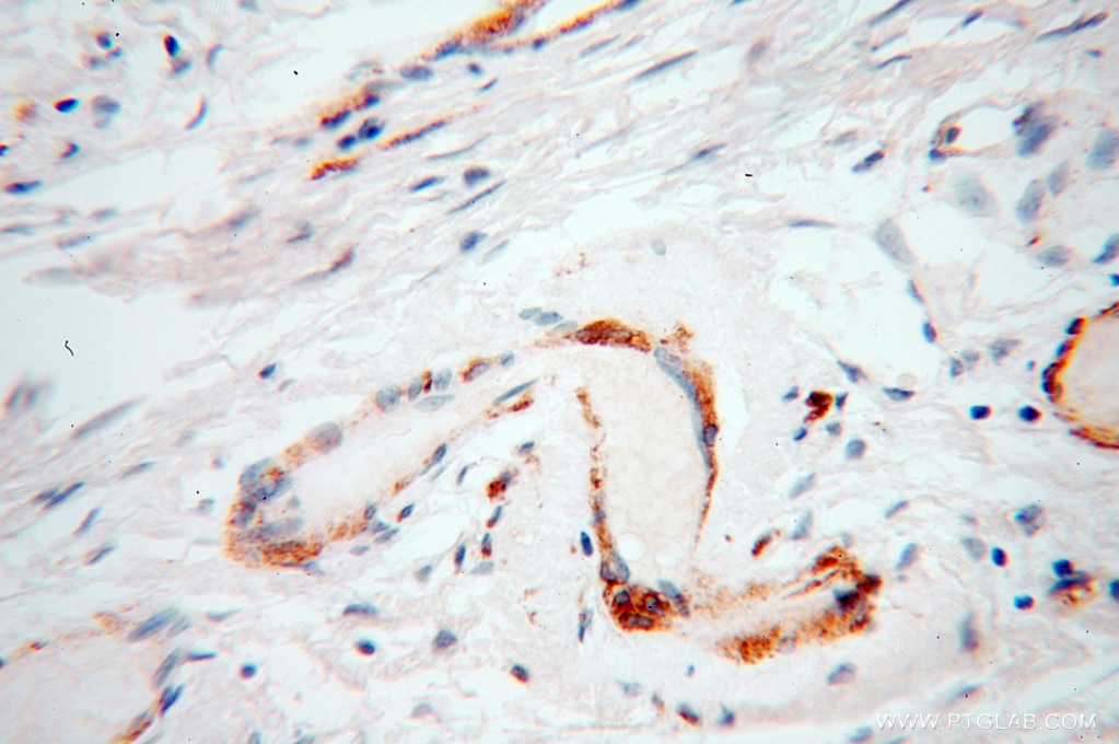 Immunohistochemistry (IHC) staining of human ovary tumor tissue using UBL4A Polyclonal antibody (14253-1-AP)