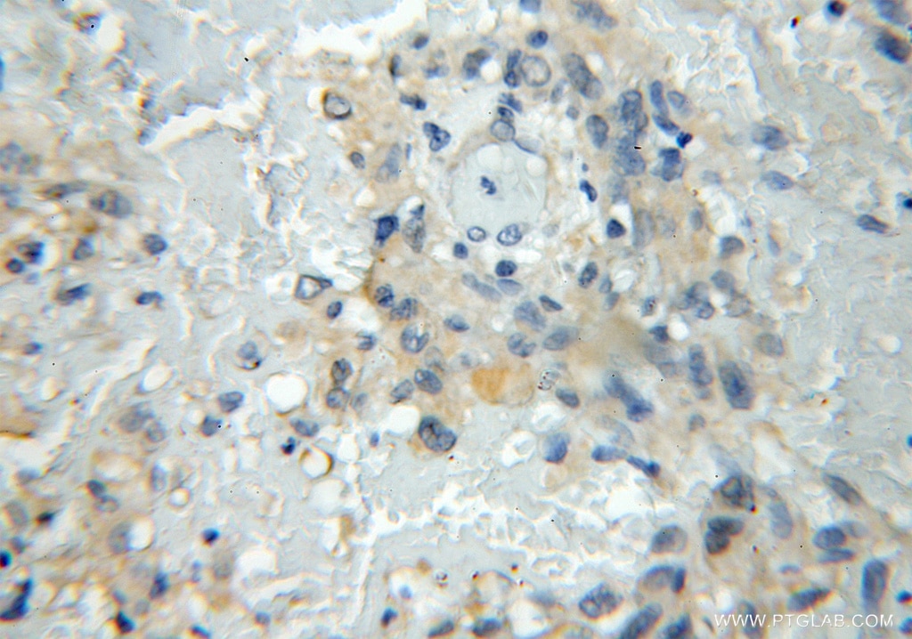 Immunohistochemistry (IHC) staining of human gliomas tissue using BMSC UbP Polyclonal antibody (11564-1-AP)