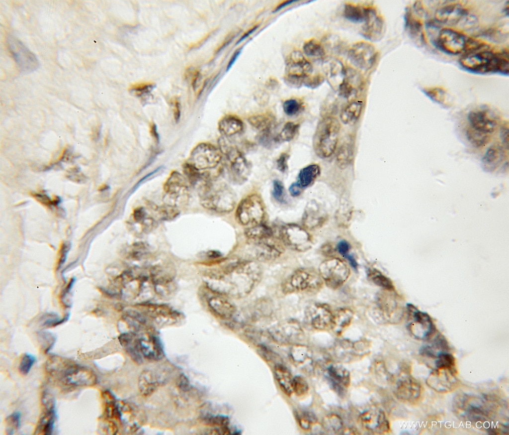 IHC staining of human ovary tumor using 12099-1-AP