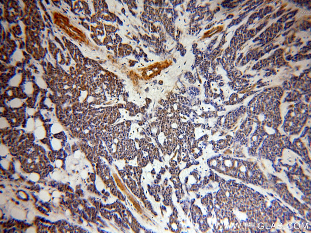 Immunohistochemistry (IHC) staining of human cervical cancer tissue using UBN1-Specific Polyclonal antibody (20363-1-AP)