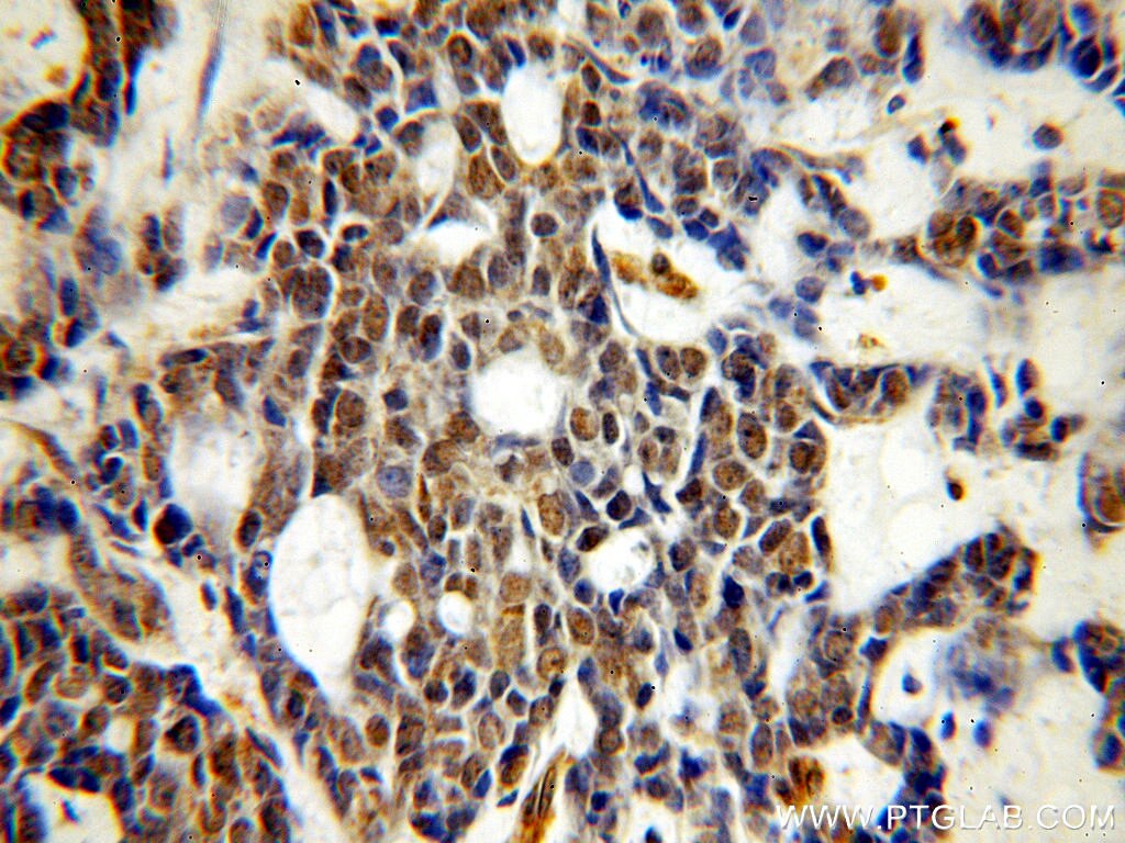 Immunohistochemistry (IHC) staining of human cervical cancer tissue using UBN1-Specific Polyclonal antibody (20363-1-AP)