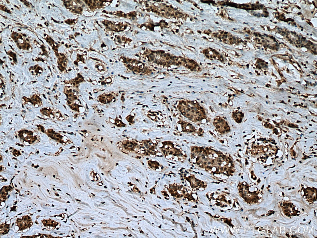 Immunohistochemistry (IHC) staining of human breast cancer tissue using UBP1 Polyclonal antibody (13856-1-AP)