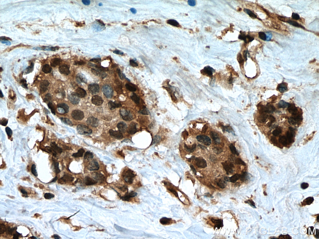 Immunohistochemistry (IHC) staining of human breast cancer tissue using UBP1 Polyclonal antibody (13856-1-AP)