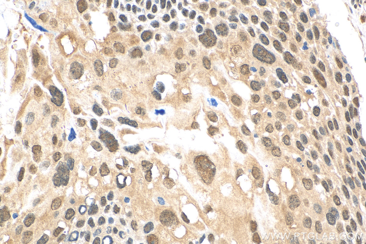 Immunohistochemistry (IHC) staining of human cervical cancer tissue using UBQLN4 Polyclonal antibody (29413-1-AP)