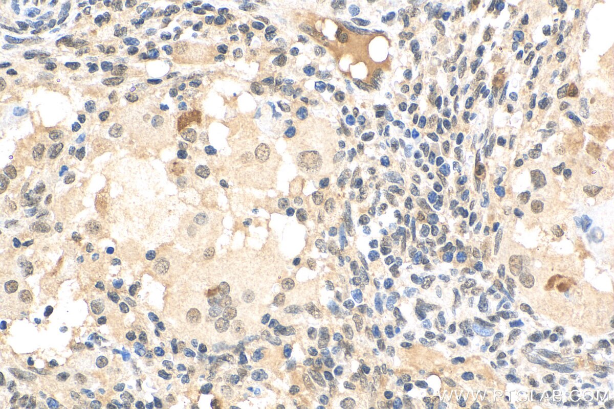 Immunohistochemistry (IHC) staining of human cervical cancer tissue using UBQLN4 Polyclonal antibody (29413-1-AP)