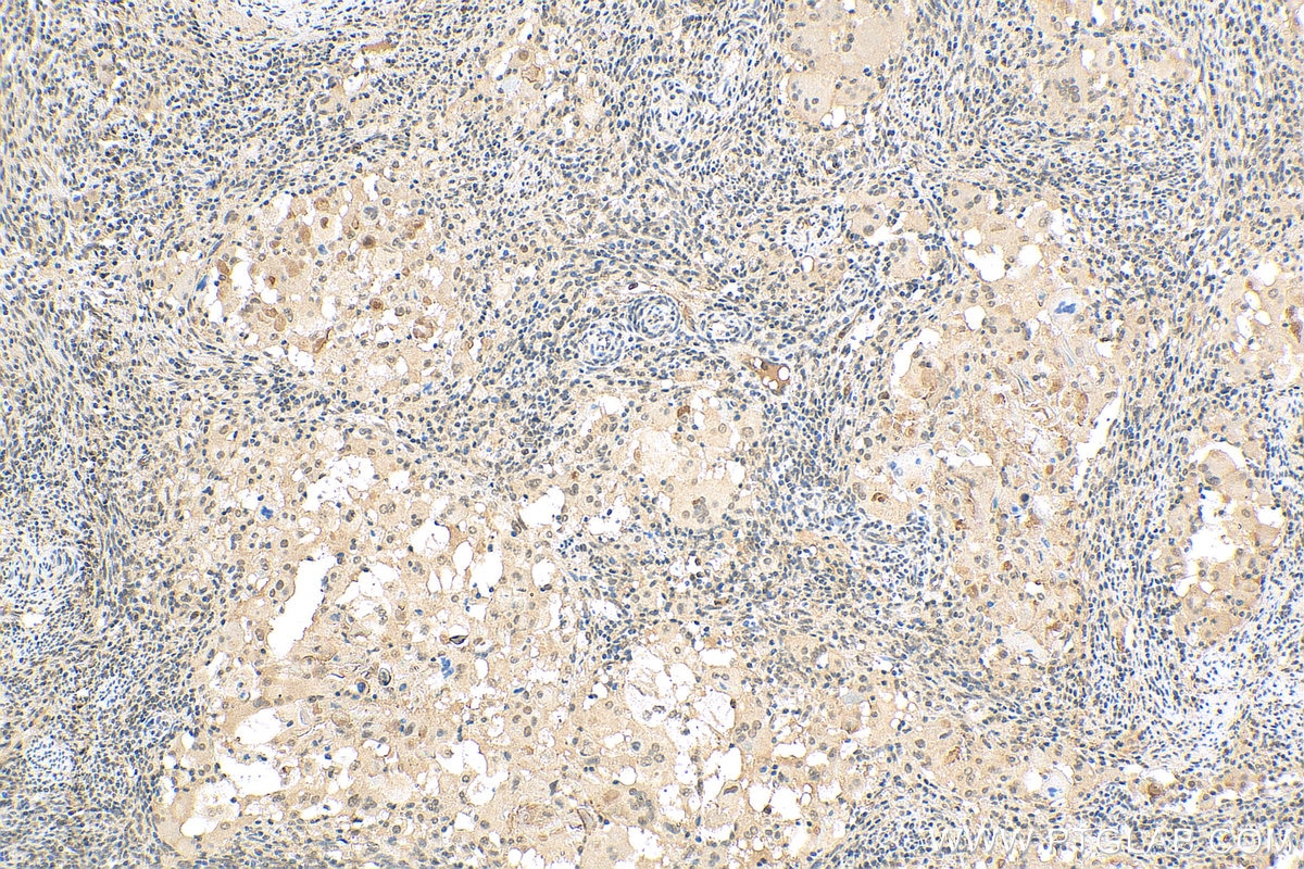 Immunohistochemistry (IHC) staining of human cervical cancer tissue using UBQLN4 Polyclonal antibody (29413-1-AP)