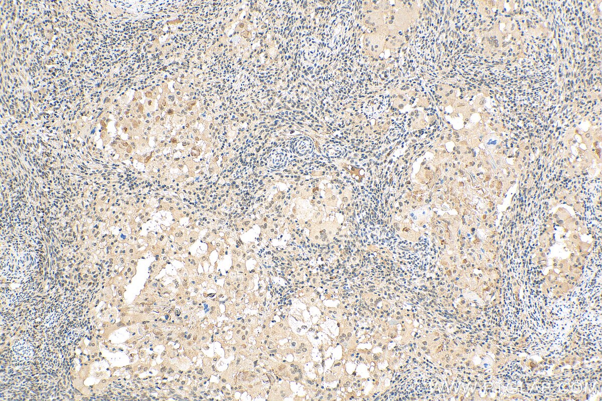 IHC staining of human cervical cancer using 29413-1-AP