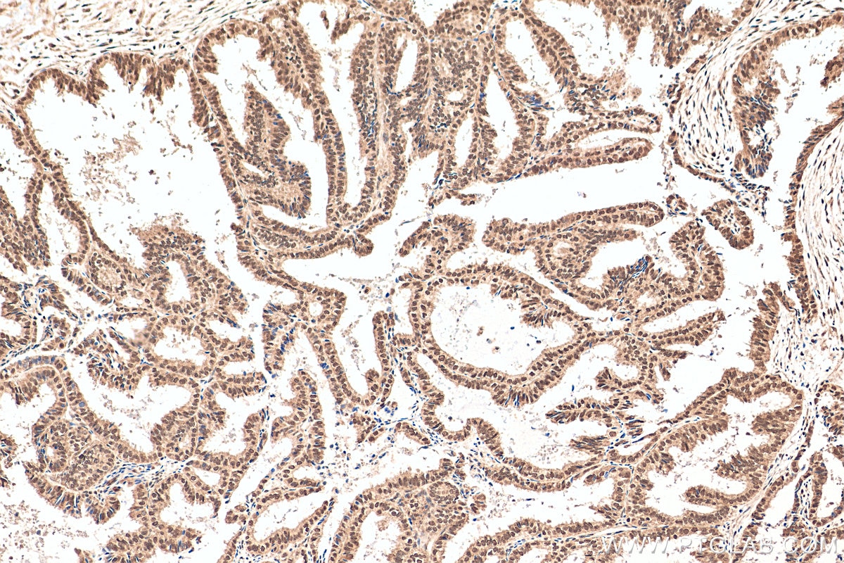 Immunohistochemistry (IHC) staining of human ovary tumor tissue using UBR2 Polyclonal antibody (18853-1-AP)